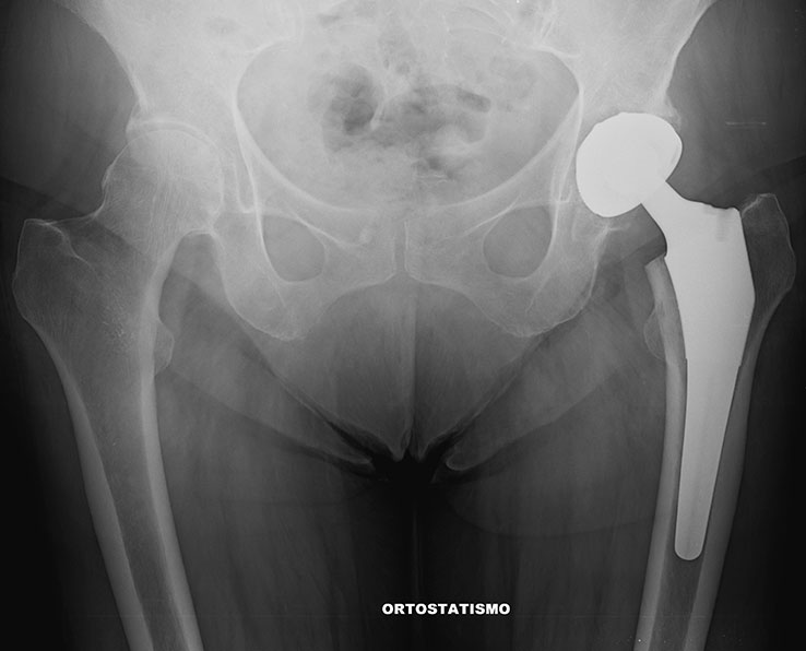 protesi anca post operatorio