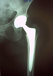 Controllo Rxgrafico di protesi d'anca a 9 anni