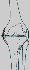 Ginocchio Varo artrosico Angolo tra asse femorale e tibia aperto medialmente, con usura del comparto mediale