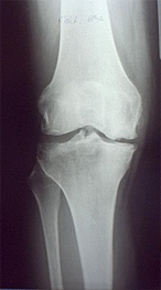 Artrosi monocompartimentale ginocchio