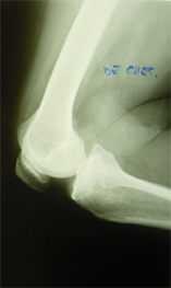 Protesi ginocchio - prima