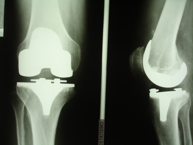 Protesi ginocchio - dopo